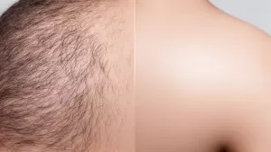 depilacja laserowa pleców cena